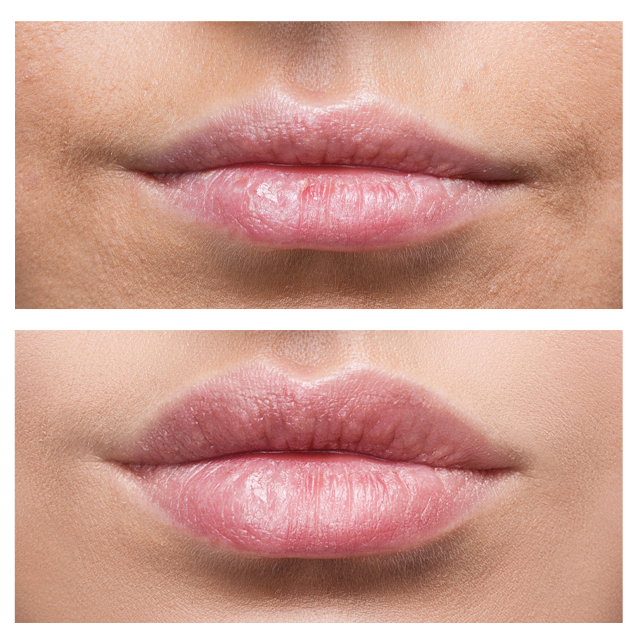 Lip before and after 1