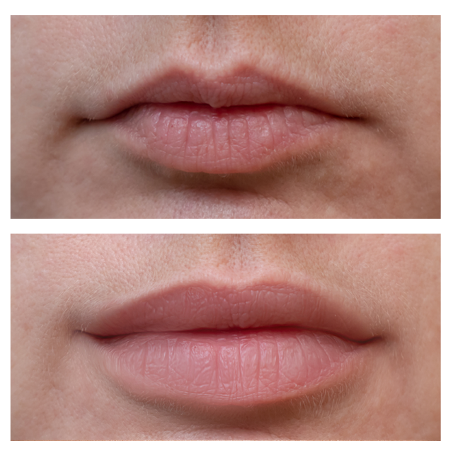Lip before and after 2