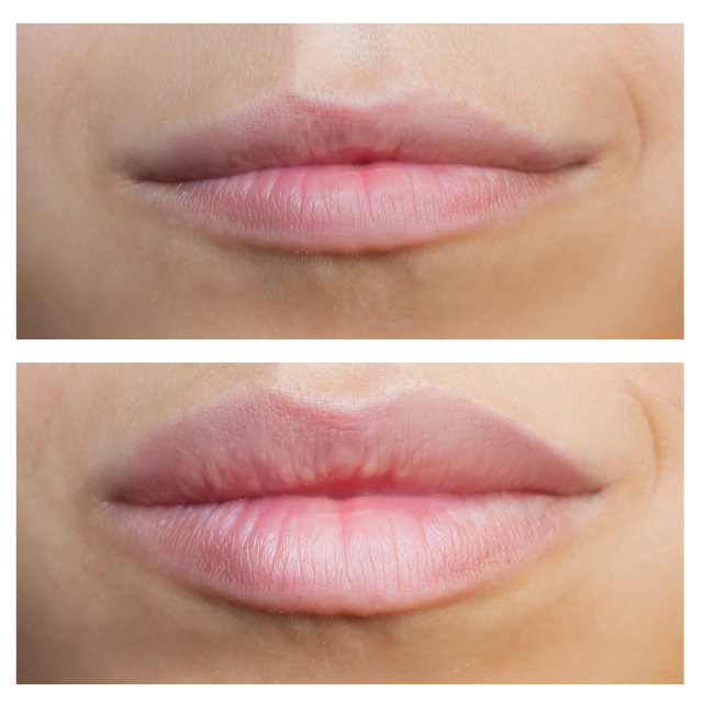 Lip before and after 3